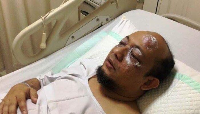 Diduga Efek Bongkar Kasus e-KTP, Novel Baswedan Disiram Air Keras